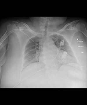Normal-chest-radiograph-obese-patient.jpeg
