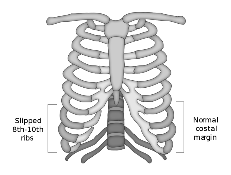 File:Slipping Rib Syndrome Example.svg.png