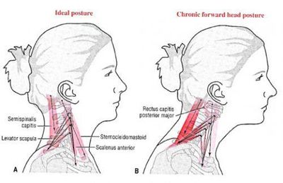 Forward Head Posture Physiopedia
