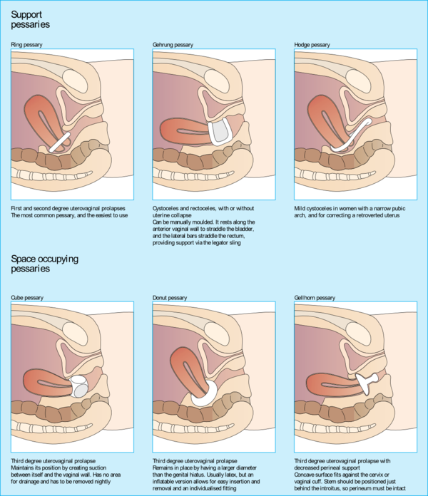 The #1 Guide to Pelvic Uterine Prolapse: What is a Prolapsed Uterus?