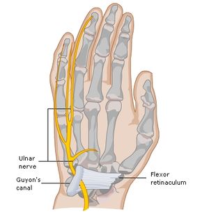 carpal tunnel syndrome physiopedia