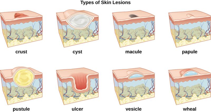 File:Skin lesions.jpg