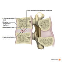 Intervertebral disc hernia into adjacent bodies sagittal view Primal.png