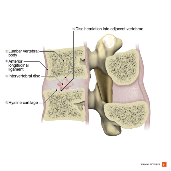 File:Intervertebral disc hernia into adjacent bodies sagittal view Primal.png