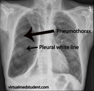 Pneumothorax xray marked.jpg