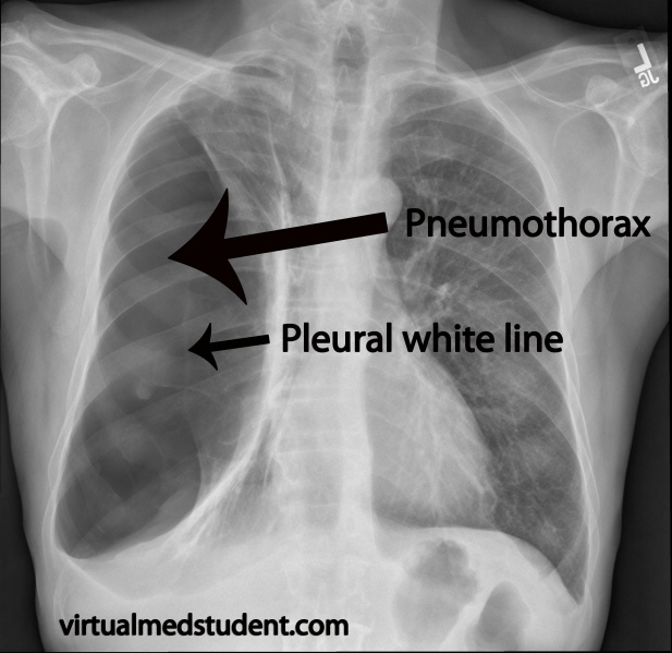 File:Pneumothorax xray marked.jpg