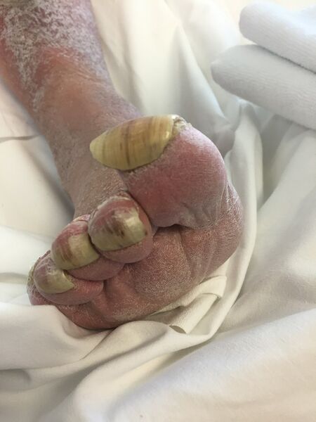 File:Ram's horn toenails on a bedridden patient.jpeg