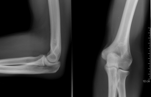 Elbow x-ray.PNG