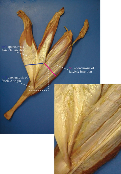 File:Medial view of a cadaver dissection of the gastrocnemius–soleus junction.png