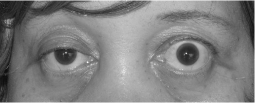 重症筋無力症眼瞼下垂症jpg