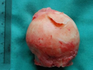 Head of femur avascular necrosis.jpg