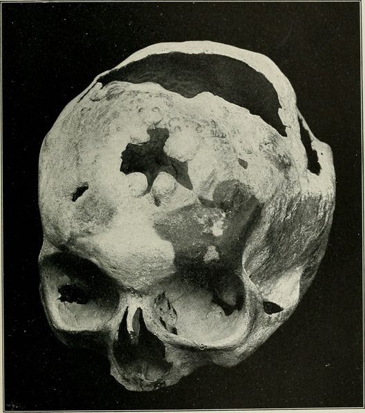 File:Osteomyelitis.jpg