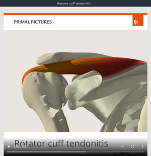Rotator cuff tendonitis.png