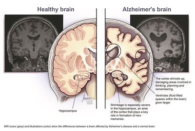 case studies on alzheimer's disease