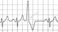 A premature ventricular contraction marked by the arrow.