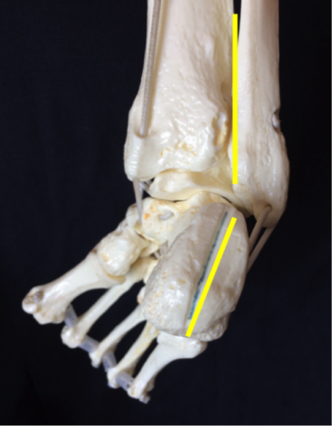File:Clubfoot9.png