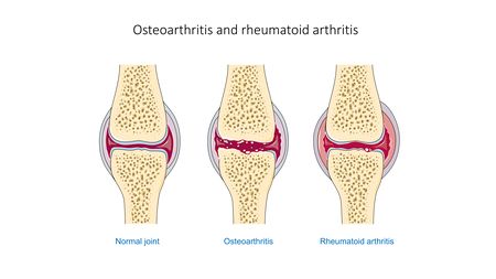 rheumatoid arthritis 4 stages