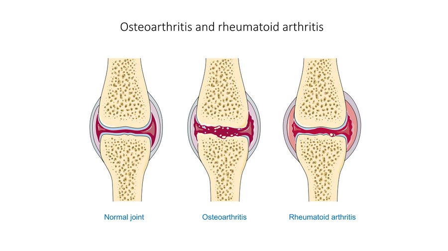 Hand Rheumatoid Arthritis Physiopedia