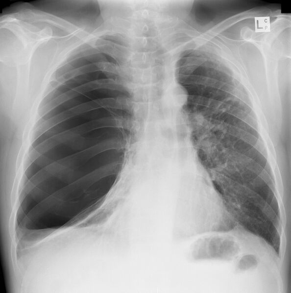 File:Giant-pulmonary-bulla.jpg