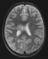 Schizencephaly MRI