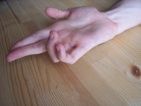 Benediction hand ulnar claw.JPG