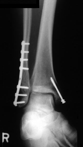 File:Ankle fracture.jpg