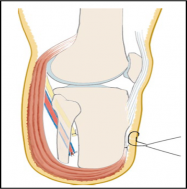 Long posterior muscular flap covering the distal end, attached ventrally to a shorter anterior flap (ventral suture)