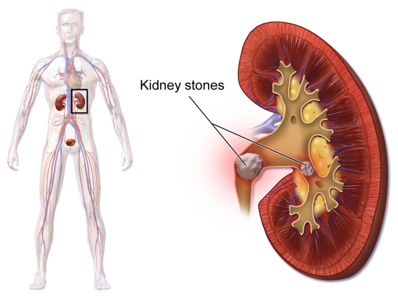 File:KidneyStones.png