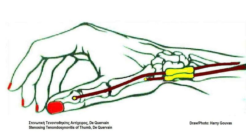 File:Stenosing tendondosynvitis of thumb De Quervain.jpg