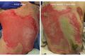 Example of unexpected burn wound deterioration. Image used with kind permission of Diane Merwarth PT.