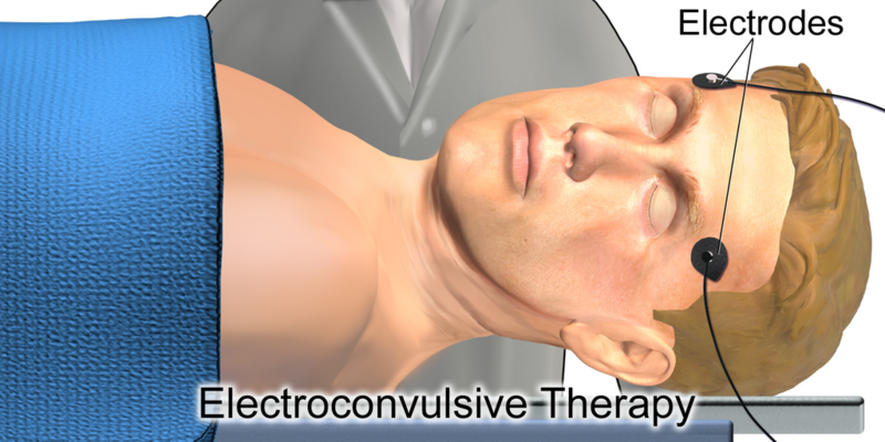 File:Electroconvulsive Therapy.png