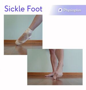 Sickle Foot.jpg