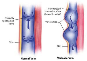 Vein Valve Anatomy.jpg