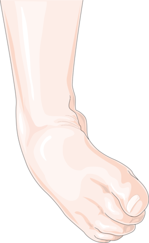Ankle sprain.png