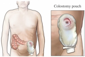 CRC colectomy.jpg