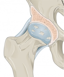 Osteoarthritis in the Hip.jpg