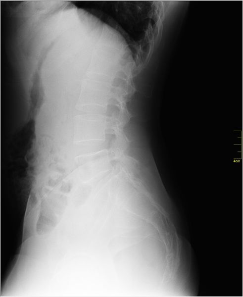 File:X-ray Lordosis.jpg