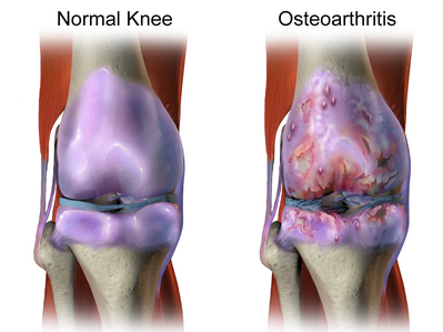 osteoarthritis aktív