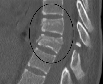 Thoracic Spine Fracture - Physiopedia