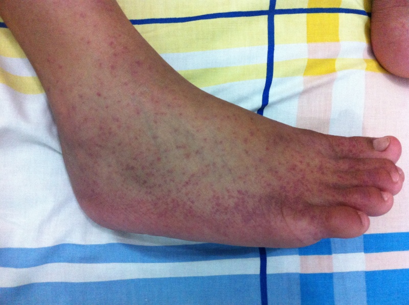 File:Chikungunya rash on R foot.jpg