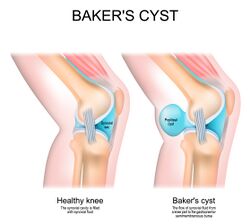Baker cyst
