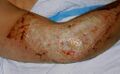 Eschar formation over burn wound on elbow