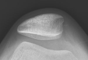 X-ray of patellar subluxation.jpg