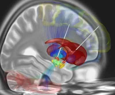Deep brain stimulation electrode placement reconstruction.png