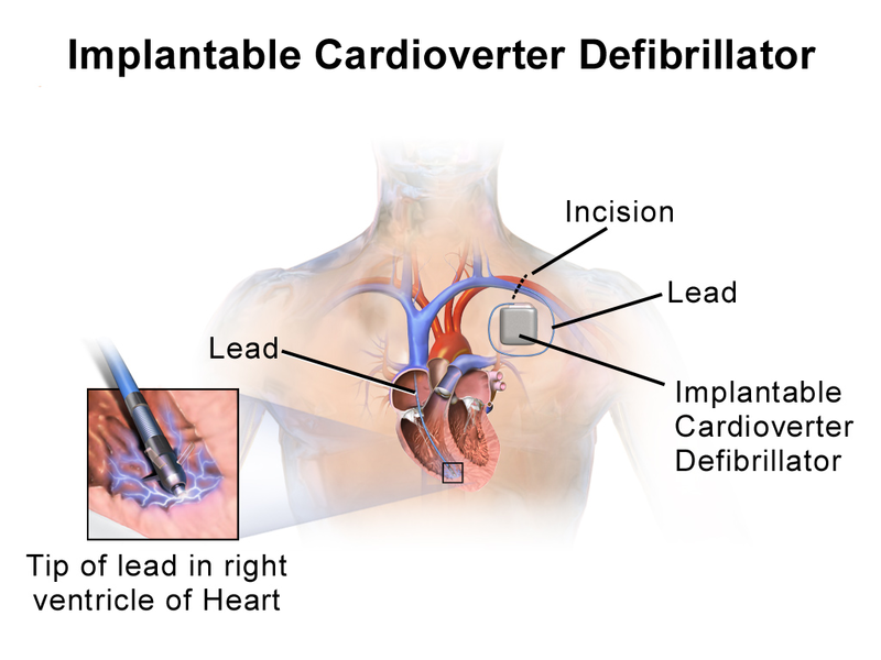 File:ImplantableCardioverterDefibrillator InsideLeads.png