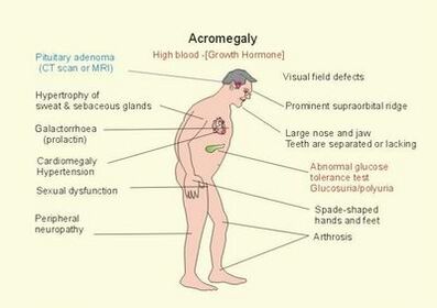 pituitary gigantism vs acromegaly