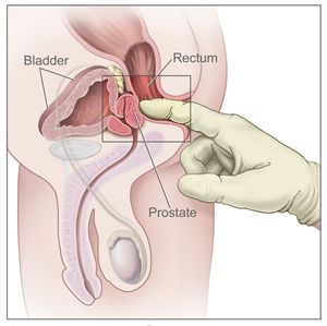 An image that illustrate the way that a rectal examinaton is done.