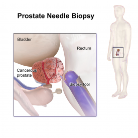 Demonstration of a prostate biopsy