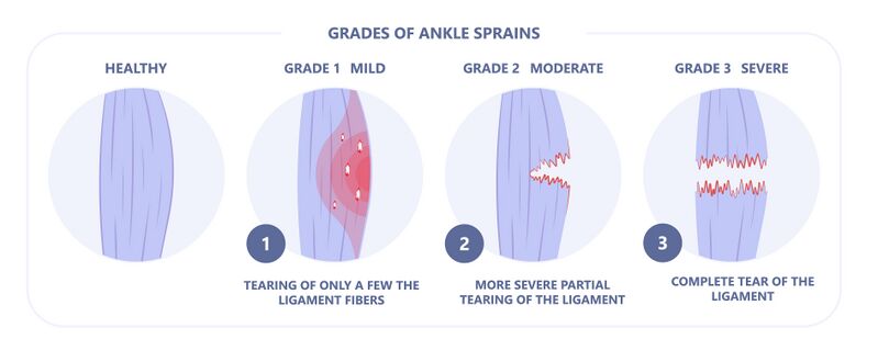 File:Adapted Shutterstock Image - Grades of Ankle Sprains - ID 1907837989.jpg