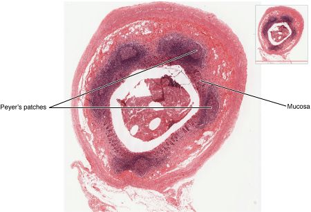 2210 Mucosa Associated Lymphoid Tissue (MALT) Nodule.jpg